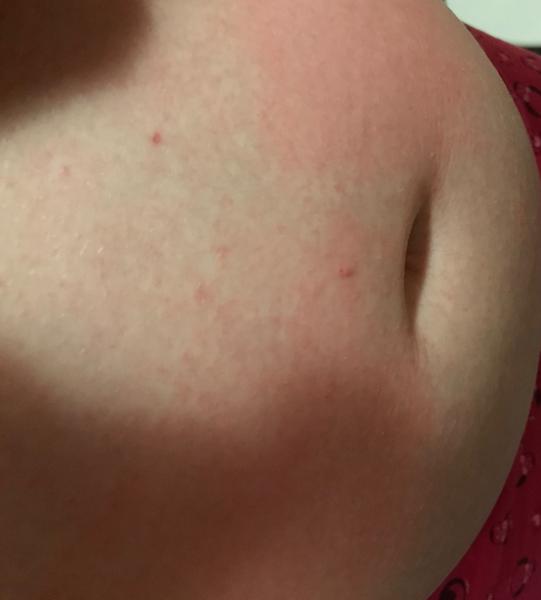 Svědění a vyrážka. Máte někdo na břiše? Vyhledat lékaře?