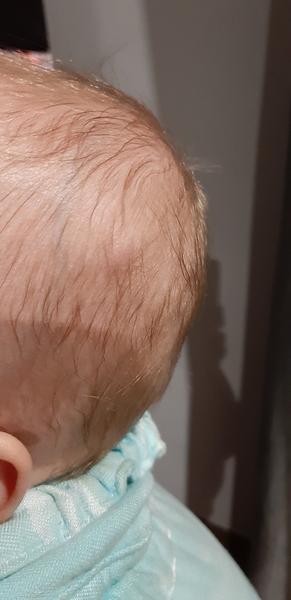 Bouchnuti do hlavy s boulí. Co myslíte?