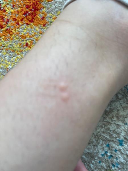 Štěnice. Jak se jich zbavit?