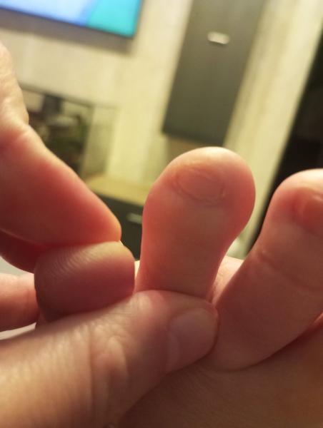 Špatné boty způsobují otok prstů na nohou?