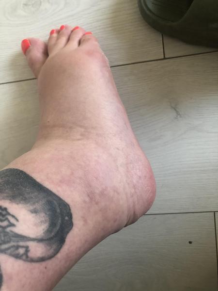 Jak řešit otoky nohou ve 24. týdnu těhotenství?