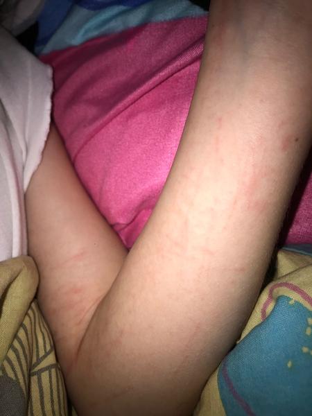 Co znamenají škrábance jako vyrážka na rukou?