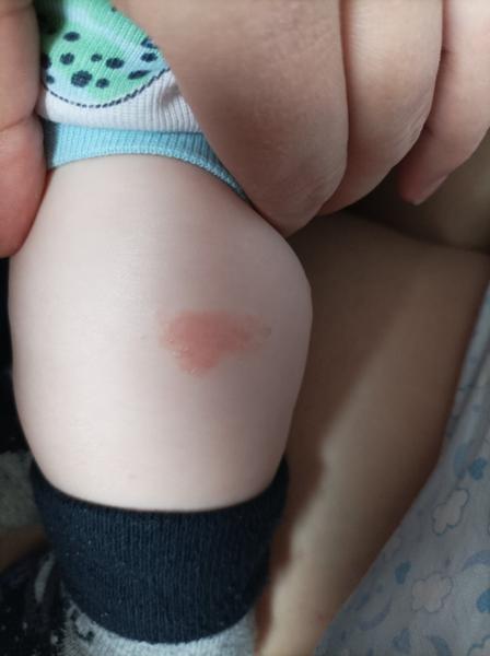 Ekzém, nebo něco jiného?