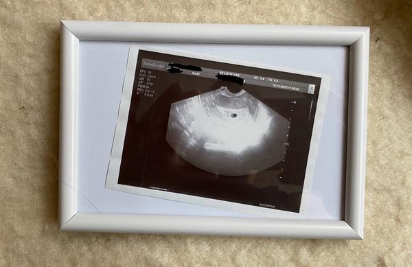 Jak zjistit týden těhotenství z ultrazvuku?