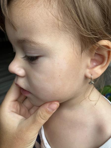 Bílé fleky na tváři u dcery. Je to vitiligo?