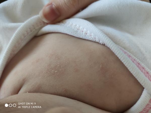 Ekzém nebo jen suchá pokožka. Co by to mohlo být?