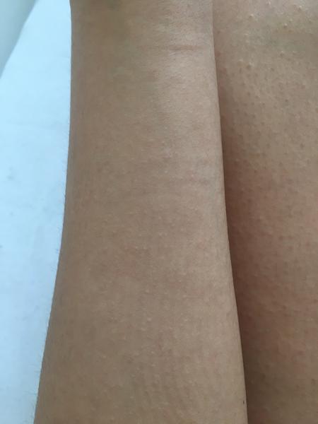 Nevysvětlitelné svědění a skvrny na pokožce: Poradíte?