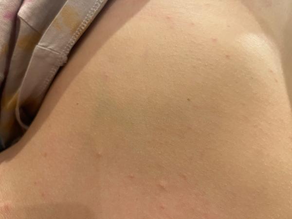 Vyrážka. Co by to mohlo být?