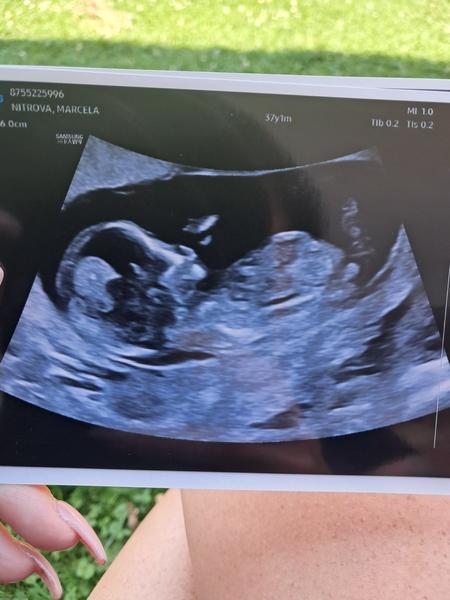 Jak tipujete pohlaví podle ultrazvuku ve 14. týdnu?