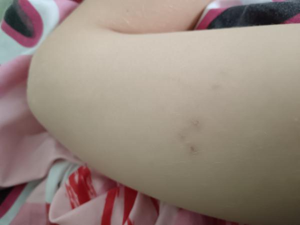 Co může znamenat podobná vyrážka u dítěte?