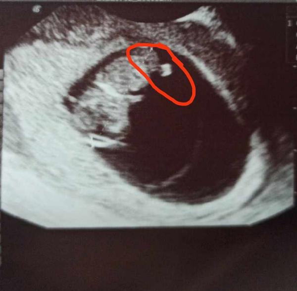 Co může znamenat nález na ultrazvuku 9+3?