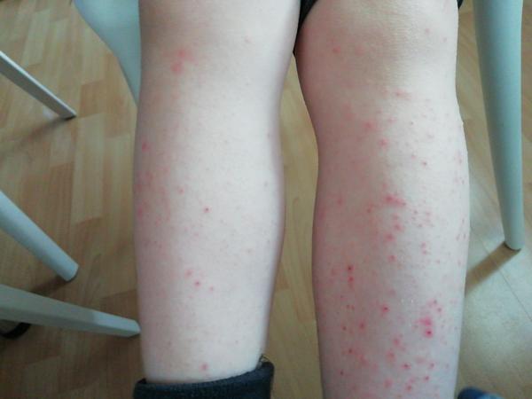 Kopřivka po jahodách. Může to být tím?