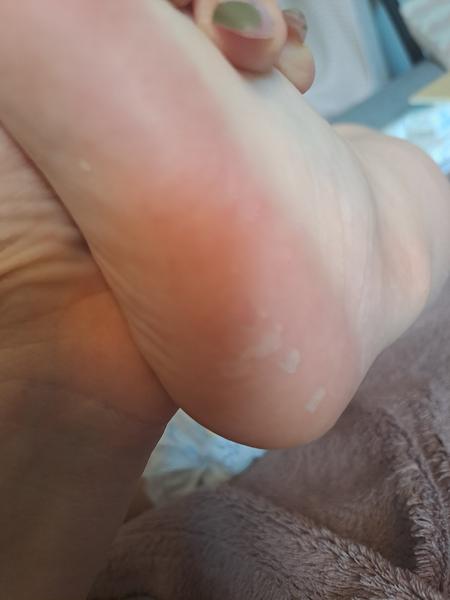 Puchýřky na nohou po sedmé nemoci: Co dělat?