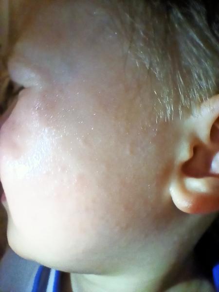 Vyrážka u dítěte. Setkal se s tím někdo?