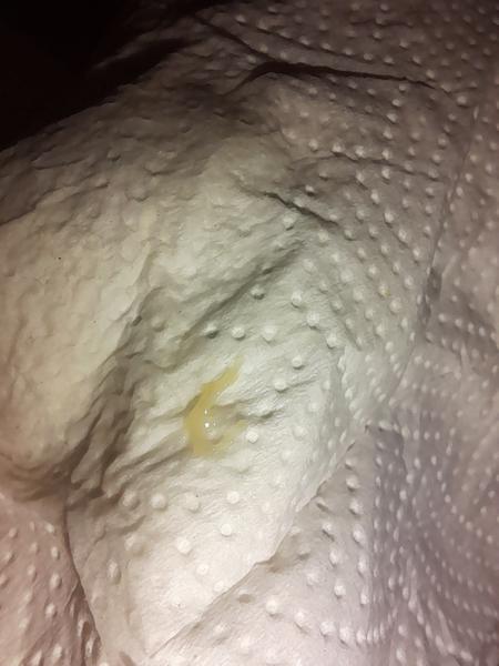 Jedná se o hlenovou zátku?