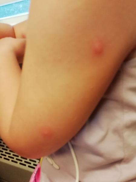 Má moje dcera vyrážku nebo štípanec z dovolené?