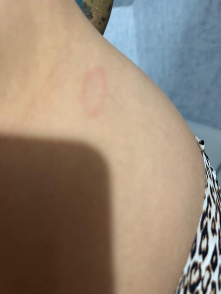 Flek. Co by to mohlo být?