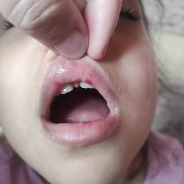 Je moučnivka důvod, proč držet dítě doma ze školky?