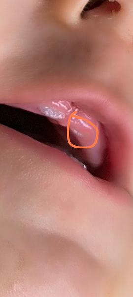 Růst vrchních jedniček u dítěte. Je to hnis nebo zánět?