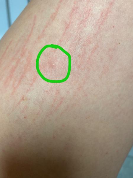 Jak řešit svědivé pupínky na rukou a nohou?