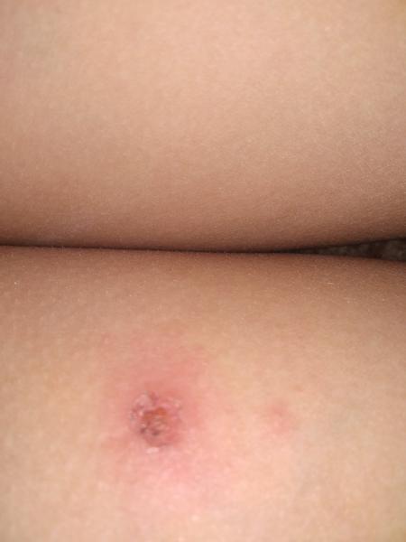 Nemoc - může to být impetigo?