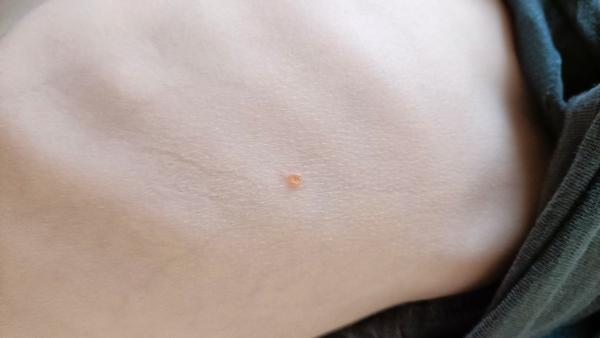 Jsou to neštovice? Pomozte prosím s identifikací příznaků.