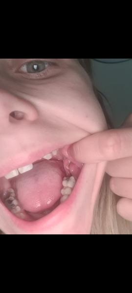 Trhání zubů po IVF: Jak zvládnout bolest a hojení?