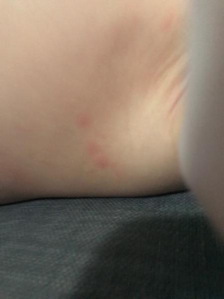 Vyrážka u dvouletého dítěte: Kdy jít na pohotovost?