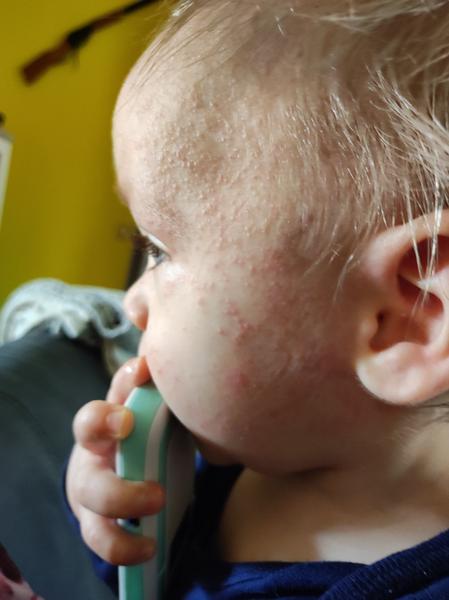 Pupínky od 4. měsíce. Co to může být?