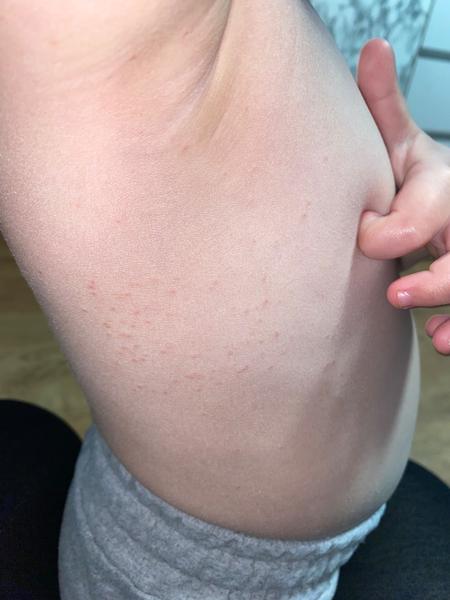 Vyrážka u tříletého dítěte. Jak to řešit?