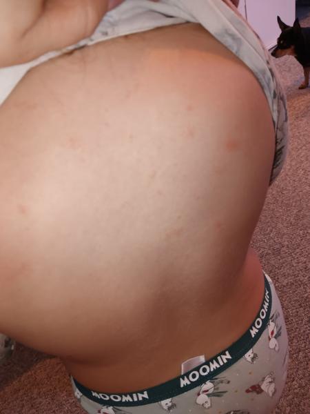 Ekzém již týden a dcera se stále drbe. O co by se prosím mohlo jednat a jak tomu pomoci, aby se to nešířilo?