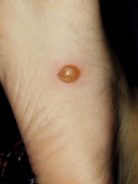 Co znamená tvrdý vřed na chodidle mé dcery?