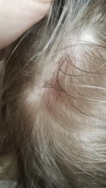 Kopřivka nebo neštovice. Co myslíte?