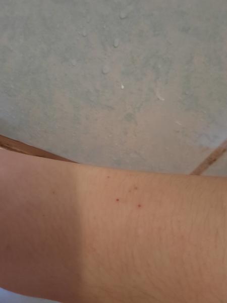 Může časté svědění celého těla znamenat svrab?