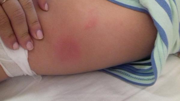 Malého něco poštípalo, čím to vyléčit?