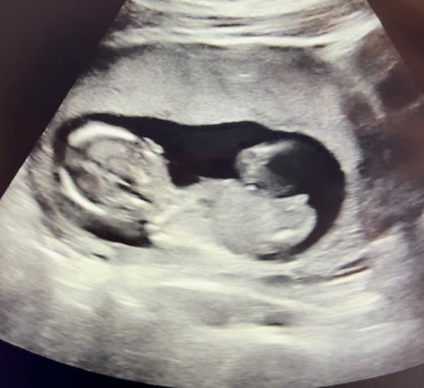 Jak určit pohlaví miminka na ultrazvuku v 15. týdnu?