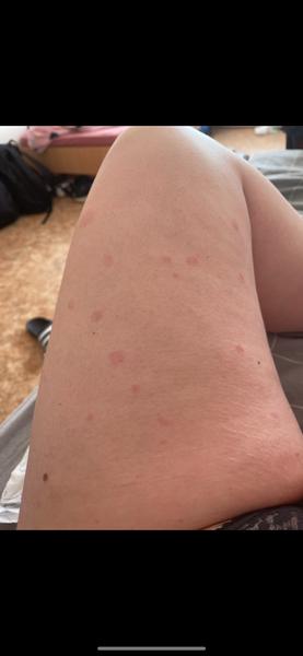 Alergie nebo kopřivka?