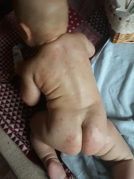 Co je to za vyrážku?