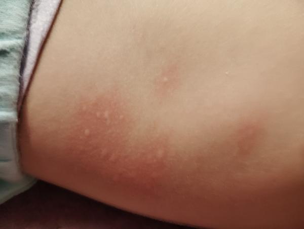 Vyrážka u dvouleté dcery. Co by mohlo způsobit?