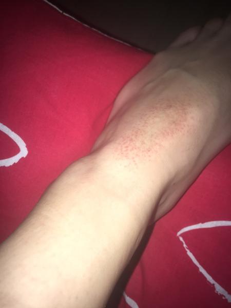 Vyrážka na noze? Co myslíte?