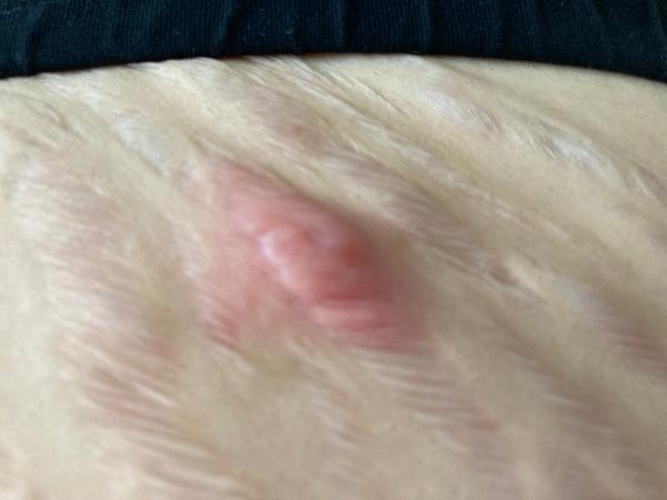 Bulka ve strii: Jak řešit zánět a bolest?