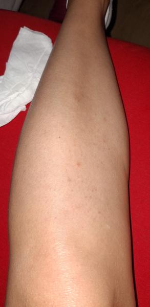 Svědění ve dne i v noci. Je to svrab?