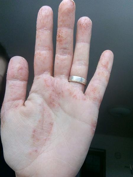 Jak vhodně léčit ekzém na rukou po porodu?