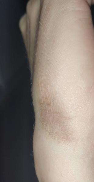 Co znamená hnědá skvrna na suché kůži?