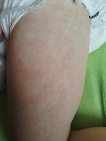 Zkušenosti s léčbou vyrážky. Co pomohlo vám?