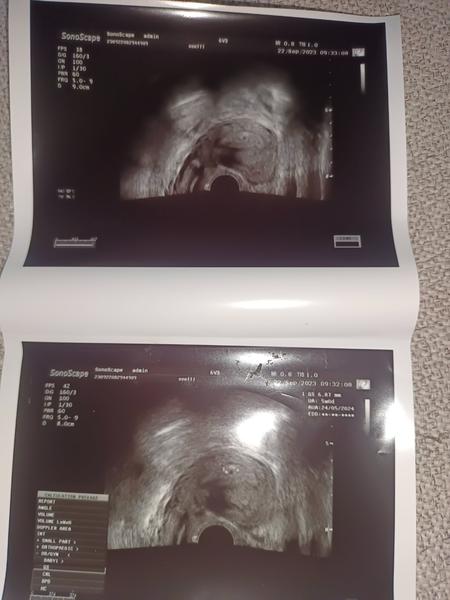 Těhotenství: Jak probíhá první ultrazvuk a krevní test?