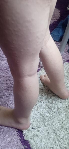 Vyrážka. Co by to mohlo být?