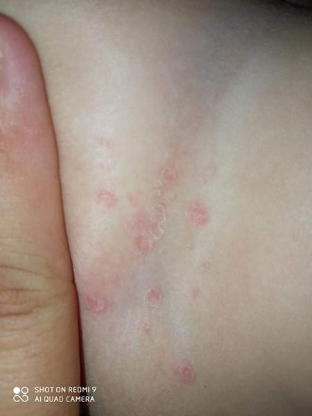 Flíčky u ročního dítěte. Co to může být?