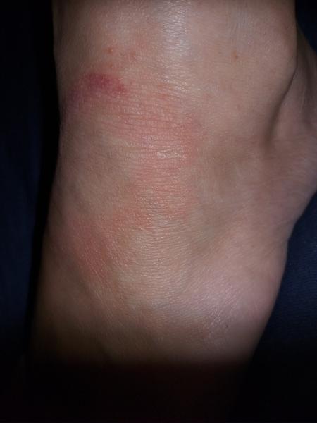 Červený flek na nártu. Borelióza, mykóza nebo něco jiného?