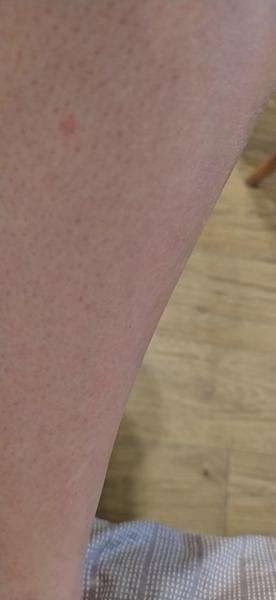 Je svědivý pupínek na noze příznakem něčeho vážného?